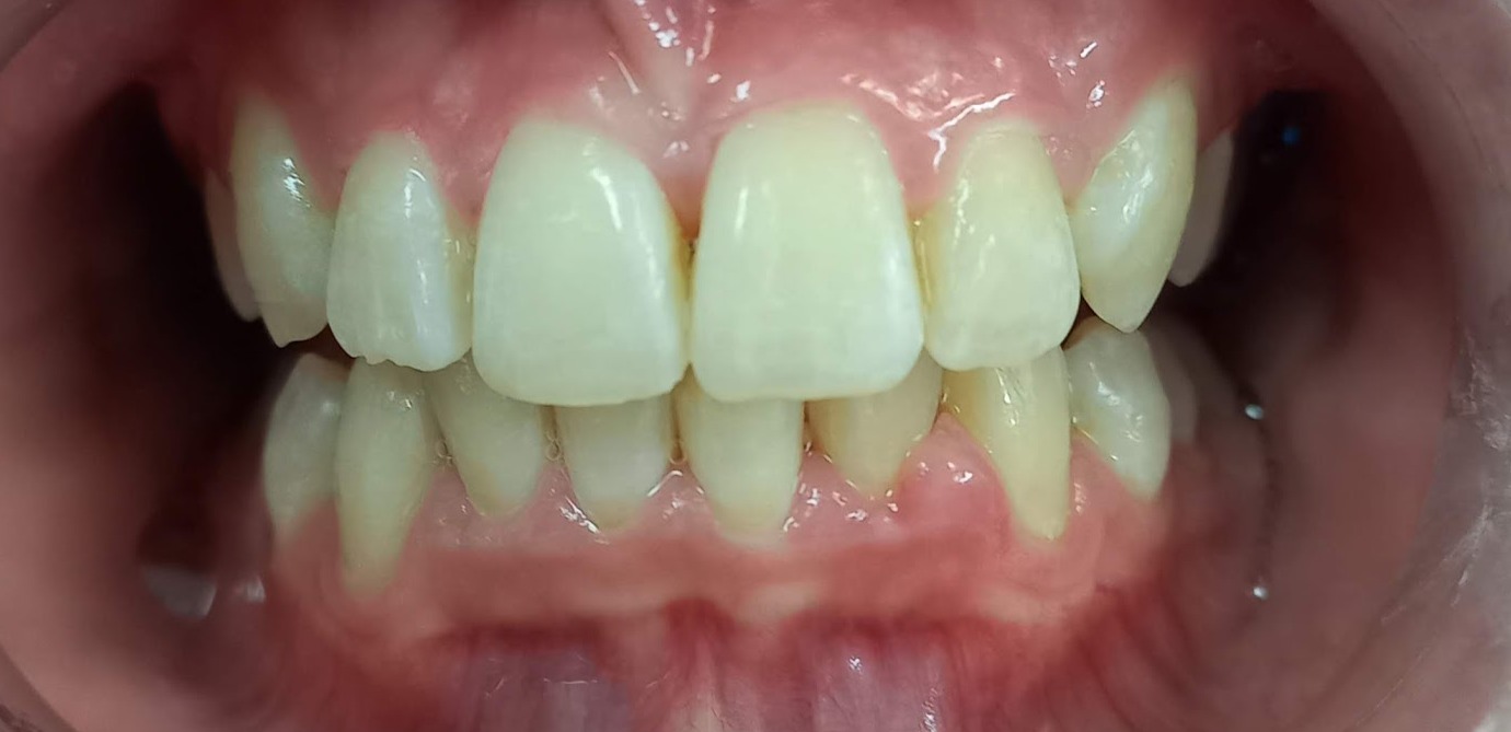 After — Anterior open bite · 14 months