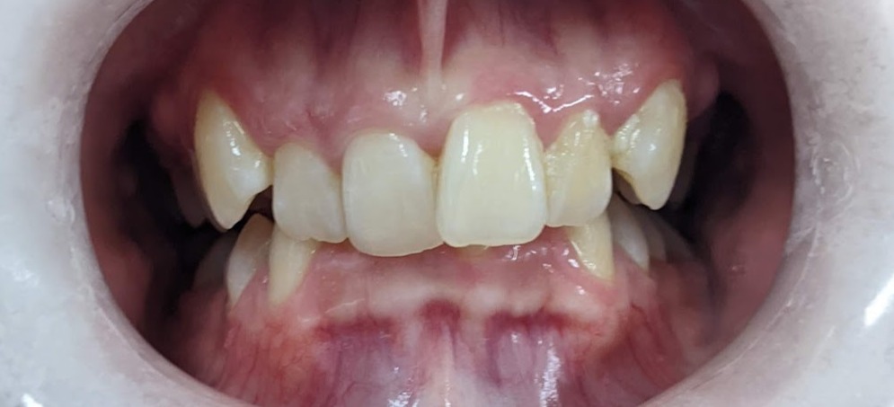 Before — Anterior open bite · 14 months