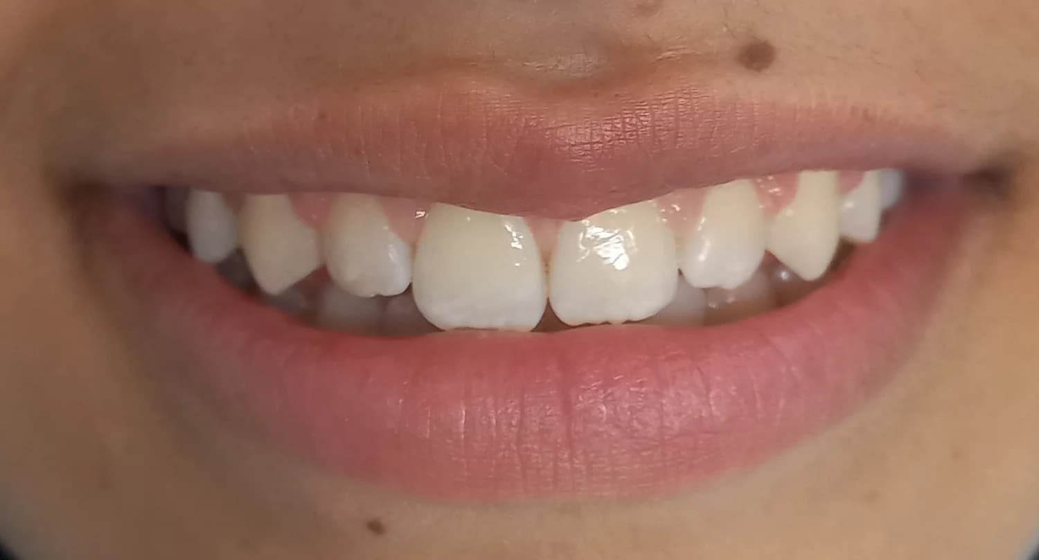 Patient A · anterior open bite · 14 months — after at Pure Dental Care
