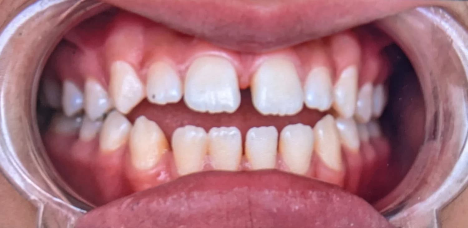Patient A · anterior open bite · 14 months — before at Pure Dental Care