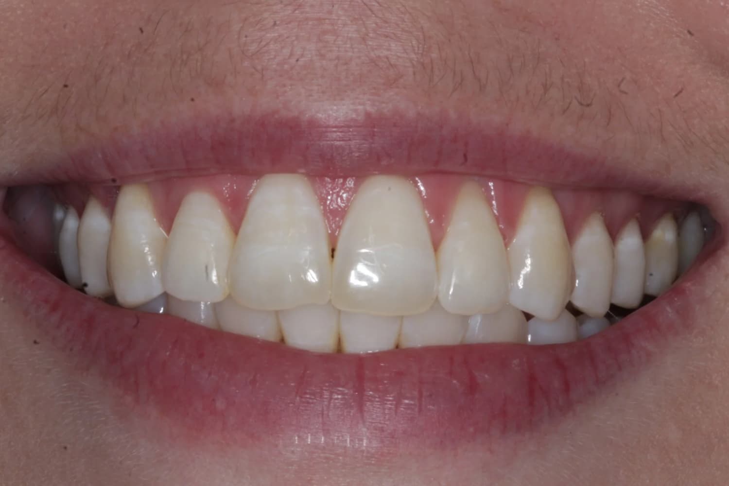 Patient C · anterior open bite · 12 months — after at Pure Dental Care