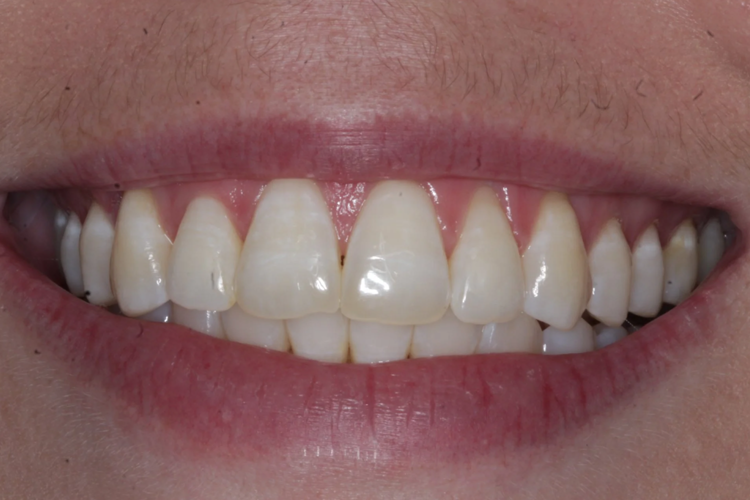After — Anterior open bite · 12 months