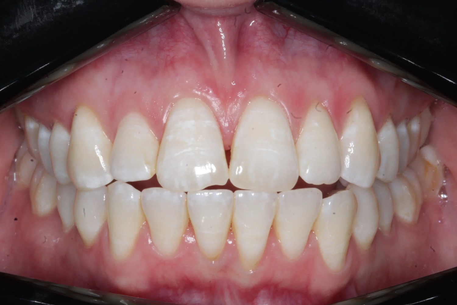 Before — Anterior open bite · 12 months